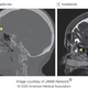 A CT scan of the woman’s brain taken in 2017 did reveal her rare birth defect, but it wasn’t noticed until after a nasal swab test for covid-19 likely injured it and caused spinal fluid to leak out.